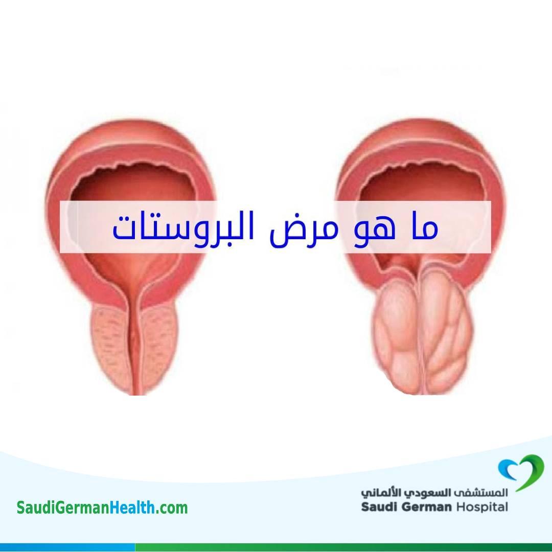 البروستاتا