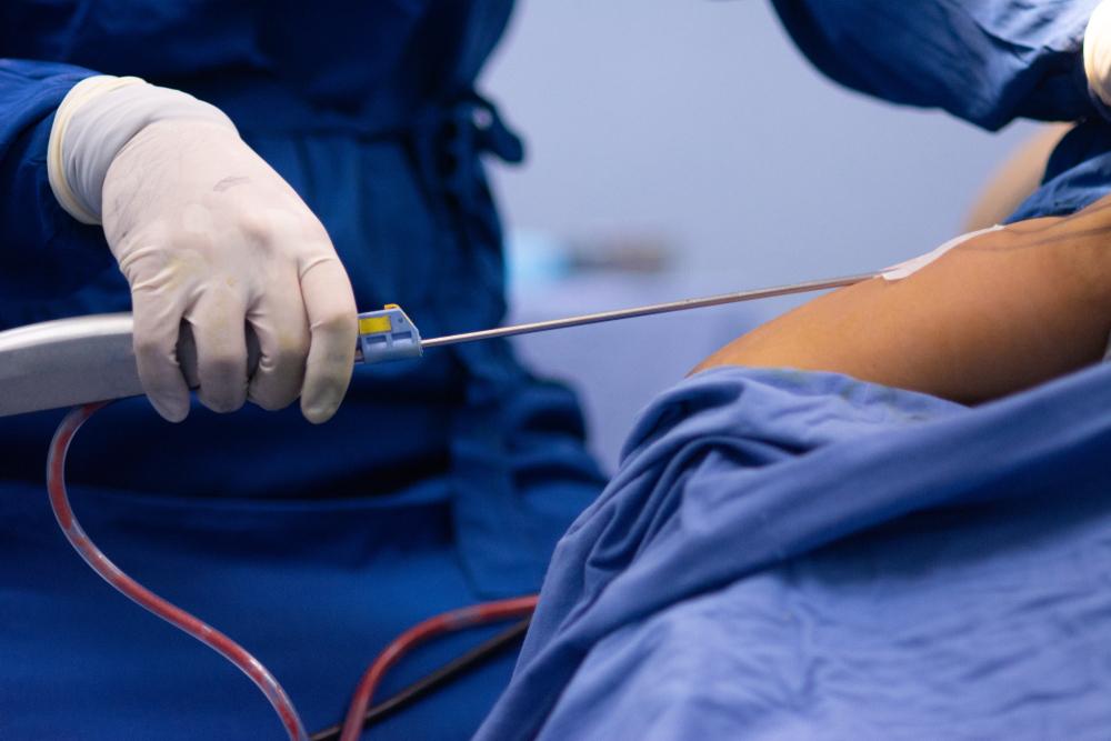 عملية تجميلية لشفط دهون من خلال البطن